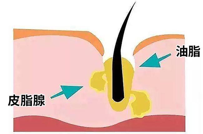 发根的白点是什么，掉发根部有小白点严重吗