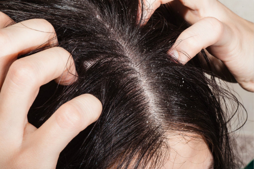 4大常见头发问题及其应对方法，你都做对了吗