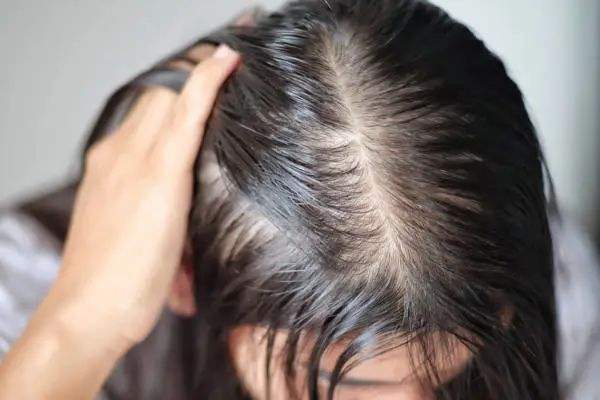 头发出油一定是脂溢性脱发吗？如何判断是否脂溢性脱发