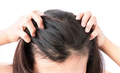 春季头皮敏感，该如何养发护发